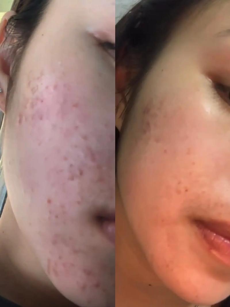 酸奶涂脸能祛痘印吗？-图3