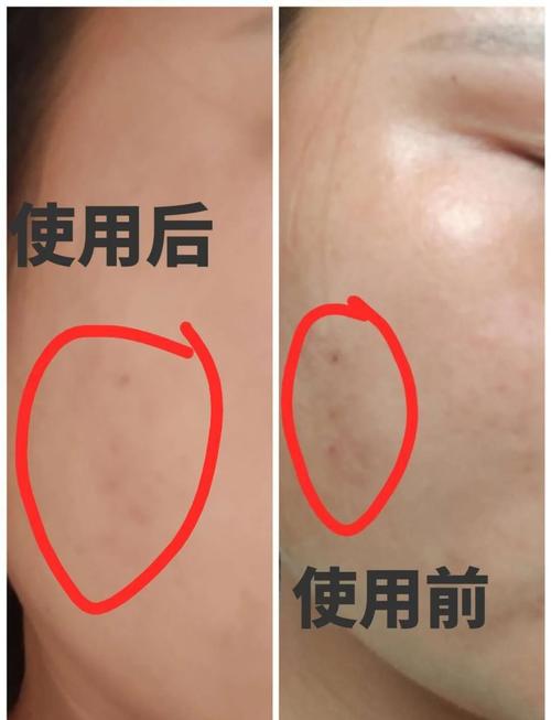 祛痘和祛印能同时进行吗？-图3