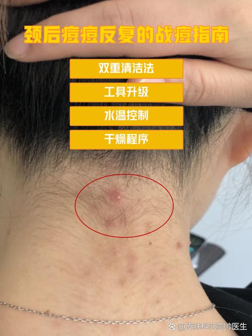 脖子上长痘怎么办？快速祛痘方法有哪些？-图2