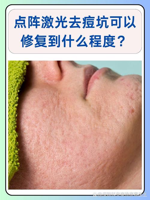 激光祛痘多久见效？-图2