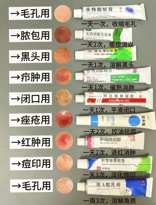 祛痘印擦什么药见效快？-图2
