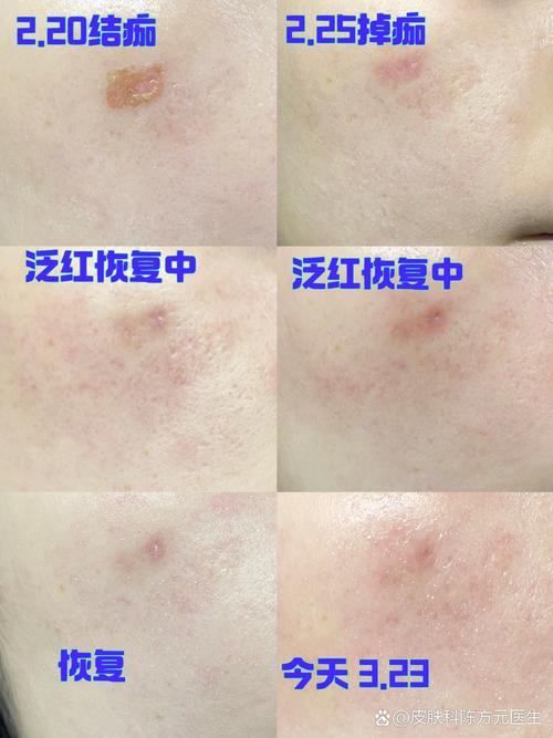 红蓝光祛痘会留疤吗？-图1