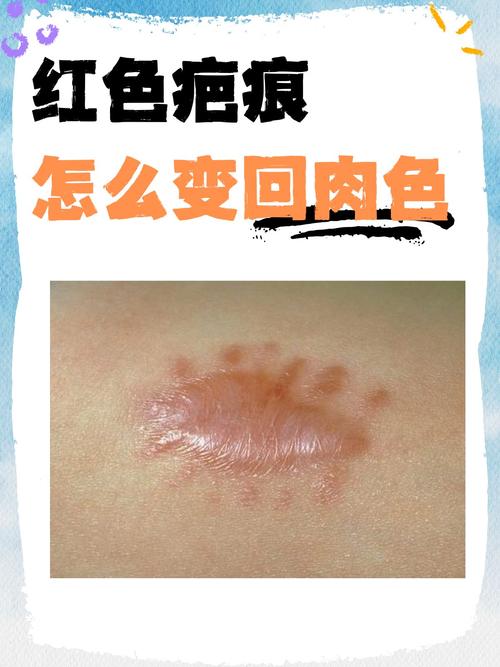 红蓝光祛痘会留疤吗？-图3