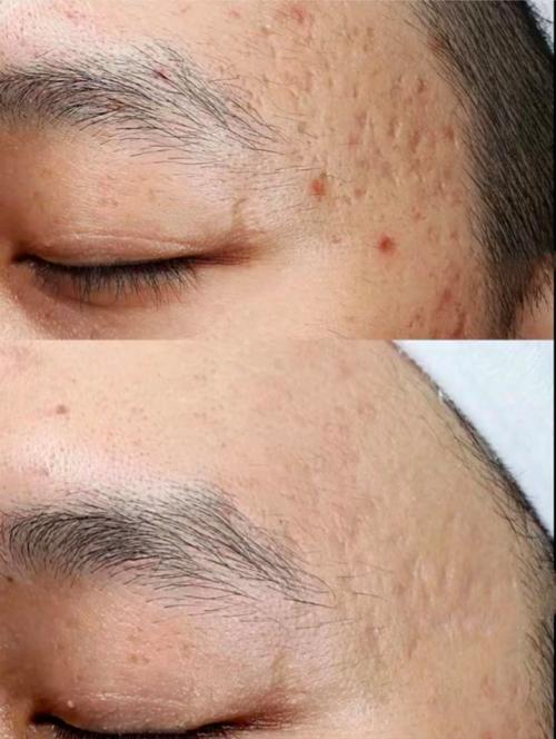 激光祛痘印后，效果能维持多久？-图3