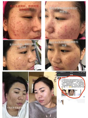 苦瓜水祛痘致脸脱皮怎么办？-图3