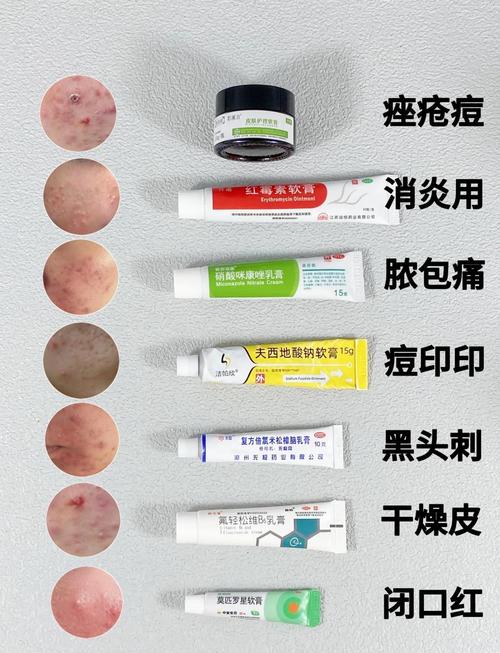 男生祛痘什么产品最有效？-图1