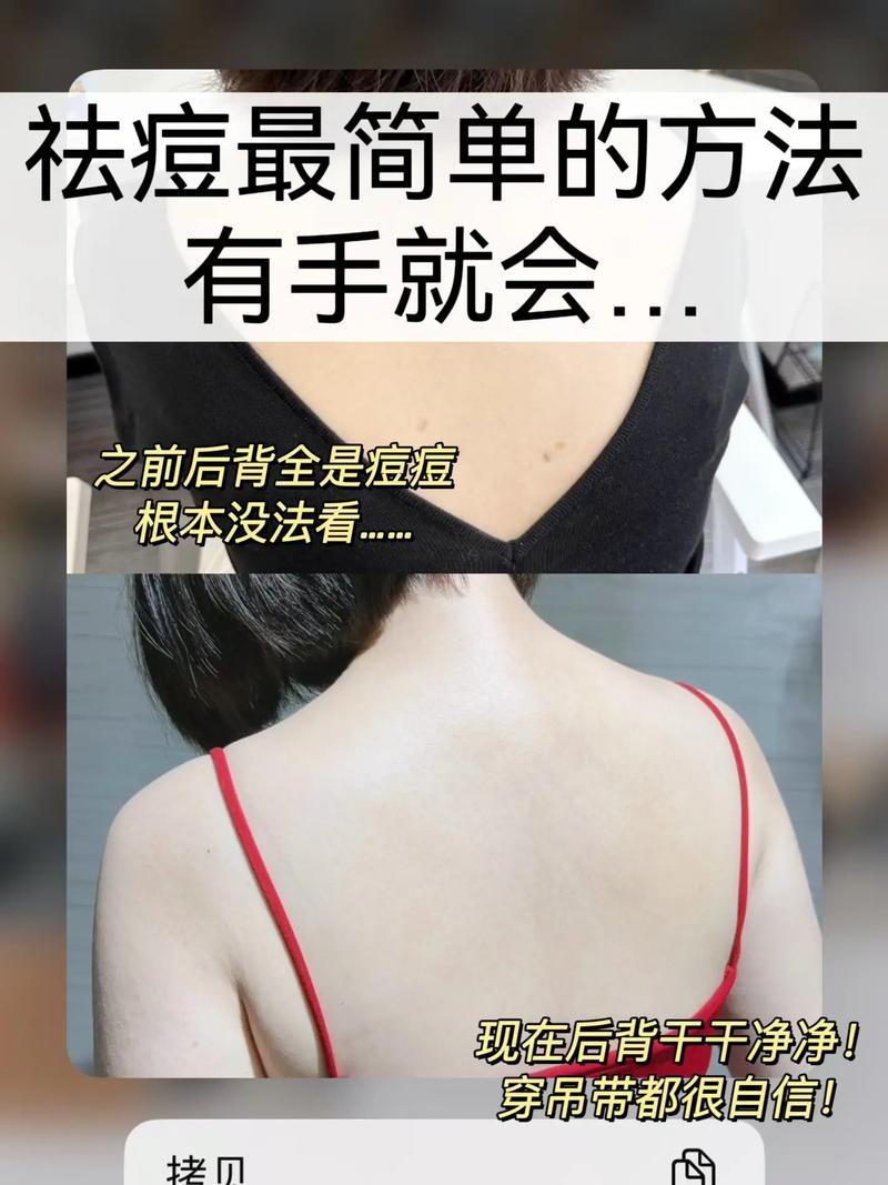 如何快速祛痘印？皮肤护理该怎么做？-图3
