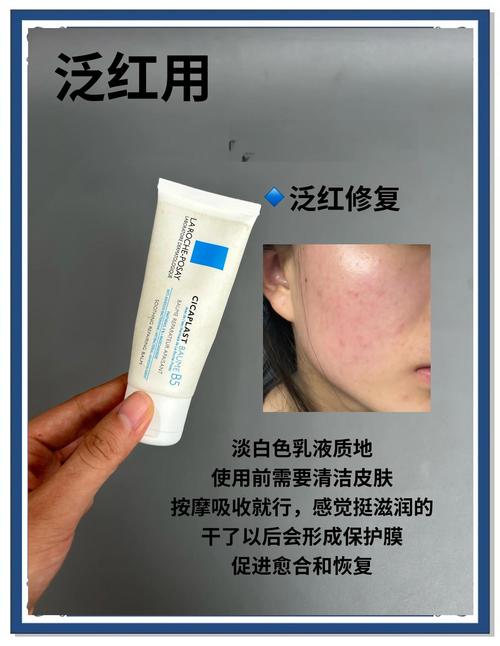 痘痘肌到底该怎么选护肤品?-图2 痘痘肌到底该怎么选护肤品?-图2