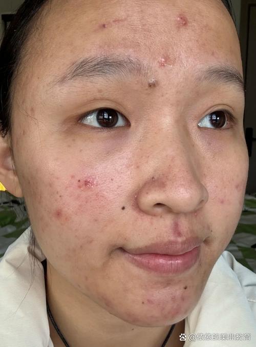 花印祛痘凝露用后痘痘为何变多？-图2