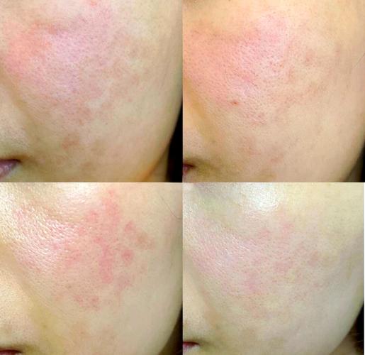 光子嫩肤祛痘印会复发吗？-图3