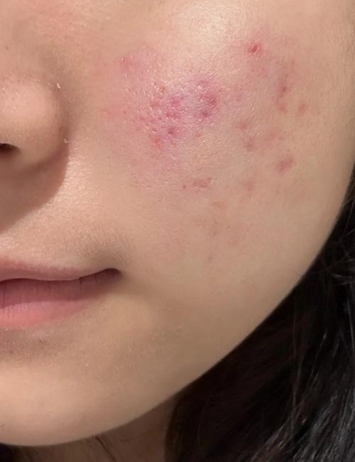 光子嫩肤祛痘印会复发吗?-图2 光子嫩肤祛痘印会复发吗?-图2