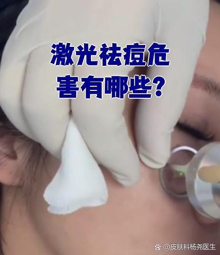 祛痘照光副作用大吗？-图2