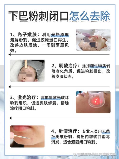 祛痘照光副作用大吗？-图3