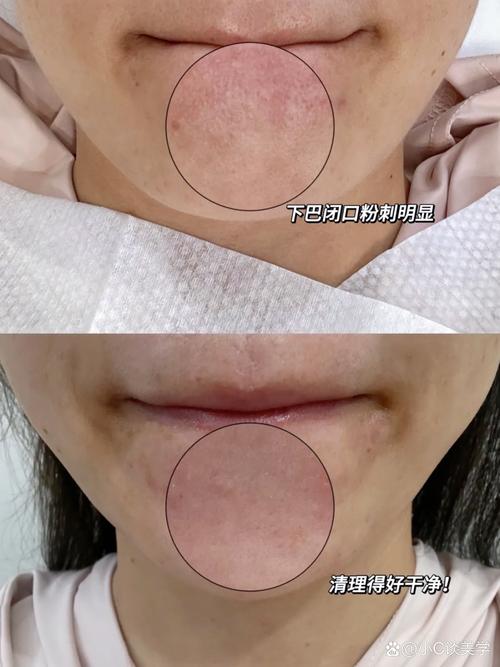 葱白能祛下巴痘印吗?-图2 葱白能祛下巴痘印吗?-图2