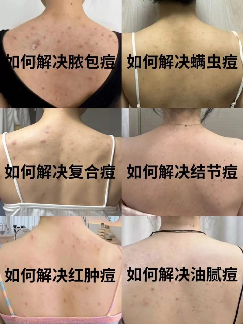 背上痘痘怎么祛?用什么药好?-图2 背上痘痘怎么祛?用什么药好?-图2