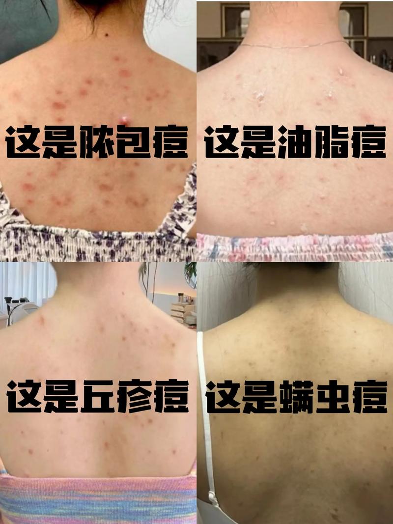 背上痘痘怎么祛?用什么药好?-图3 背上痘痘怎么祛?用什么药好?-图3