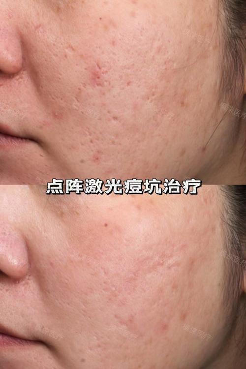 祛痘坑激光种类怎么选？-图2