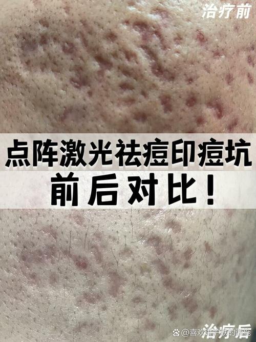 祛痘坑激光种类怎么选？-图1