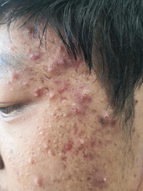 囊肿型痤疮可以贴祛痘-图2