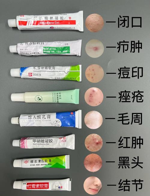 囊肿型痤疮可以贴祛痘-图1