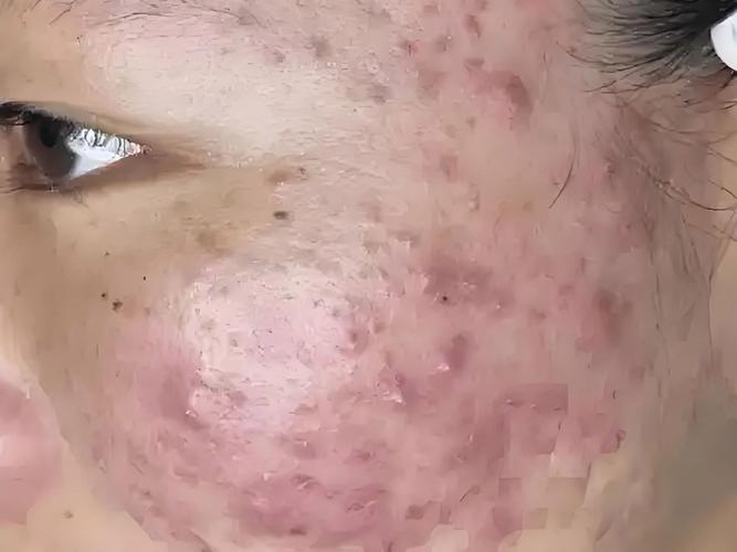 囊肿型痤疮可以贴祛痘-图3