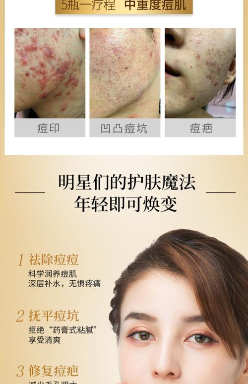 用清水加什么快速祛痘-图3 用清水加什么快速祛痘-图3