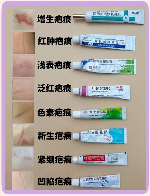 买个牌子的祛痘印疤痕-图1