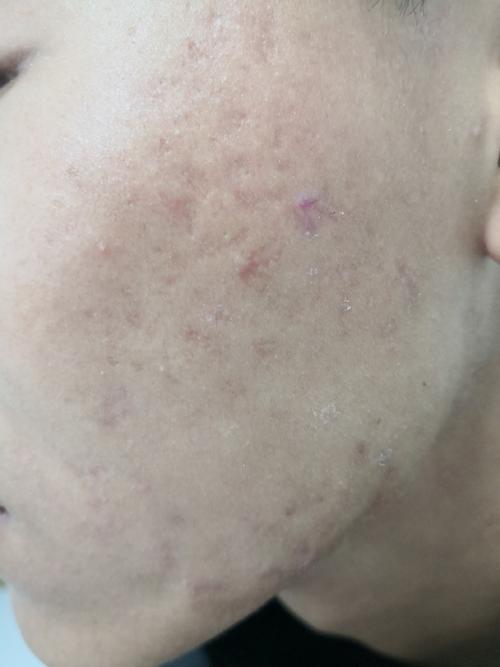 买个牌子的祛痘印疤痕-图3