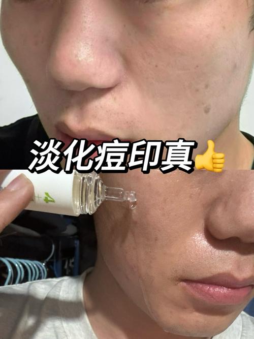 ddq男士祛痘怎么样-图2