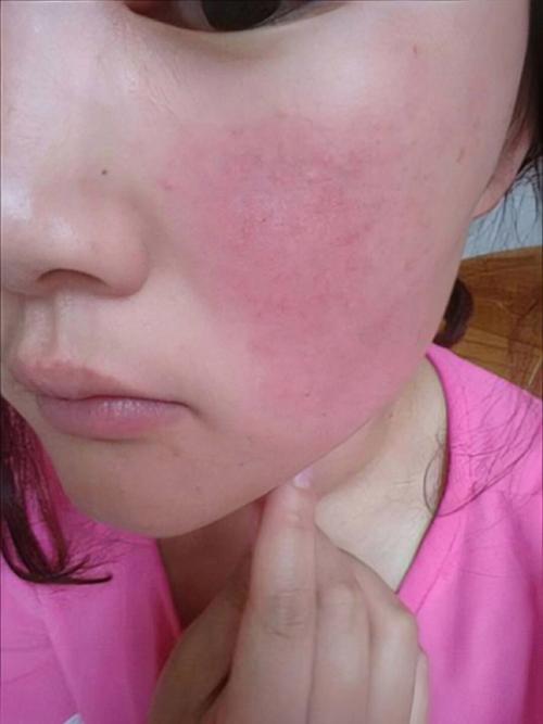 用了护肤品脸又红又痒-图1
