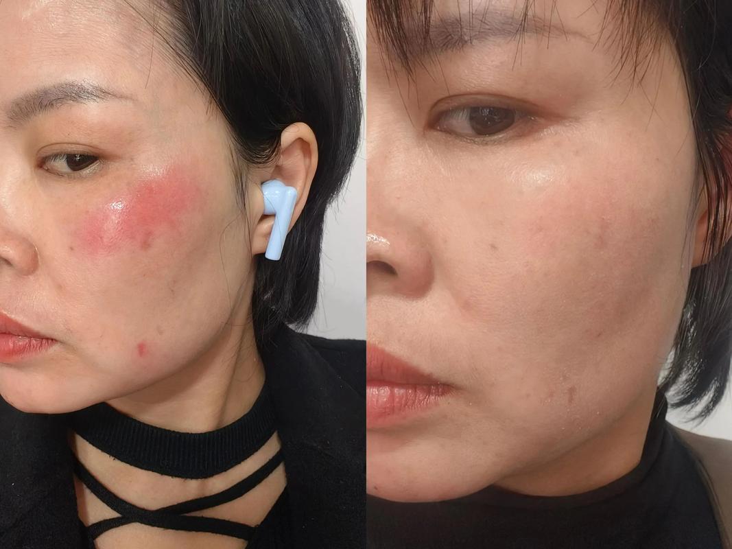 用了护肤品脸又红又痒-图3