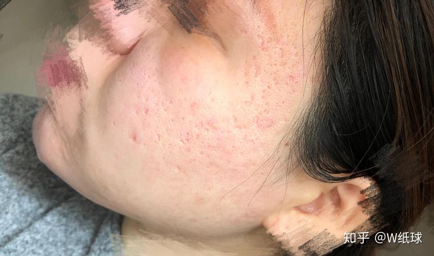 昆山祛痘医院长海有何独特优势？-图3