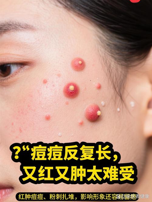 酒精和甘油混合祛痘吗-图1