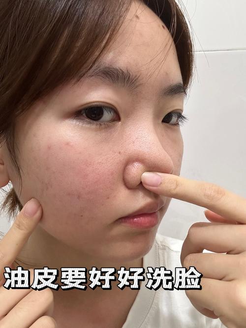 食盐洗脸真的能祛痘吗？-图2