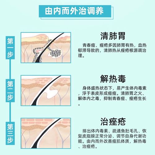 祛痘内调中药有哪些？-图3