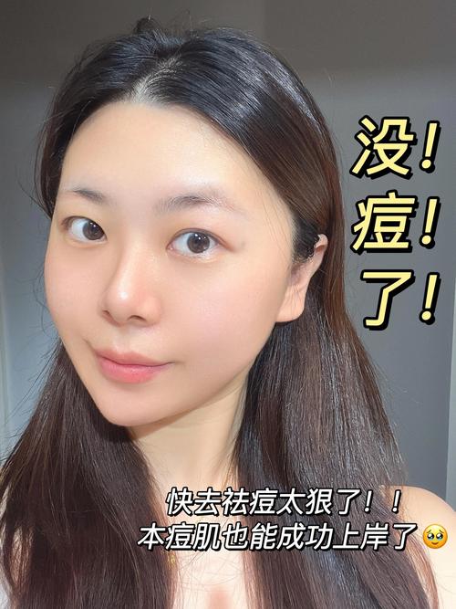 化妆能真正祛痘吗？-图1