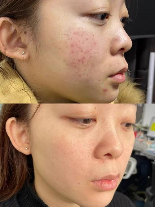 化妆能真正祛痘吗？-图2