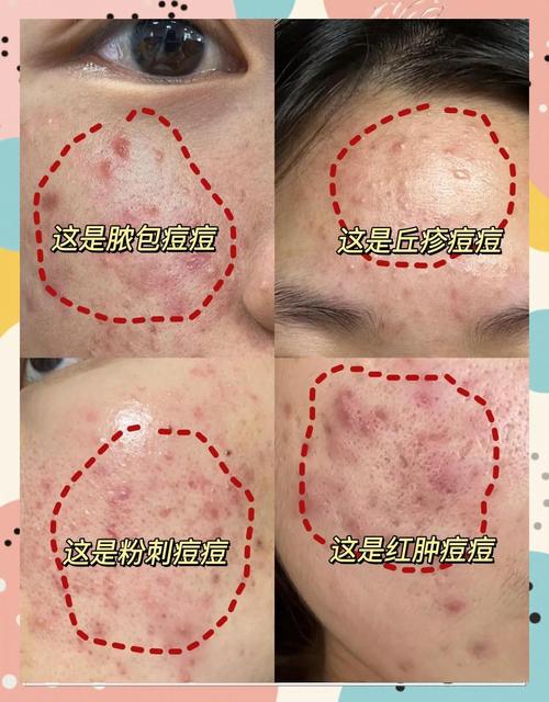 化妆能真正祛痘吗？-图3