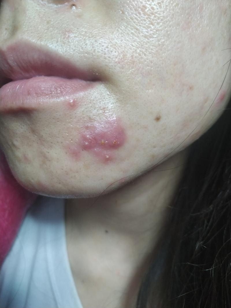 祛痘产品致痘起泡，是过敏还是刺激？-图2