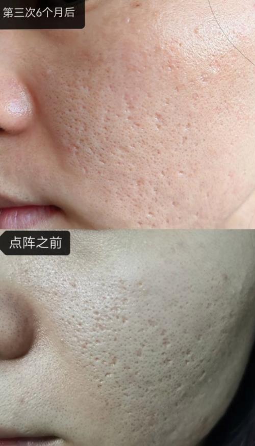 祛痘印激光还是光子更好?-图1 祛痘印激光还是光子更好?-图1