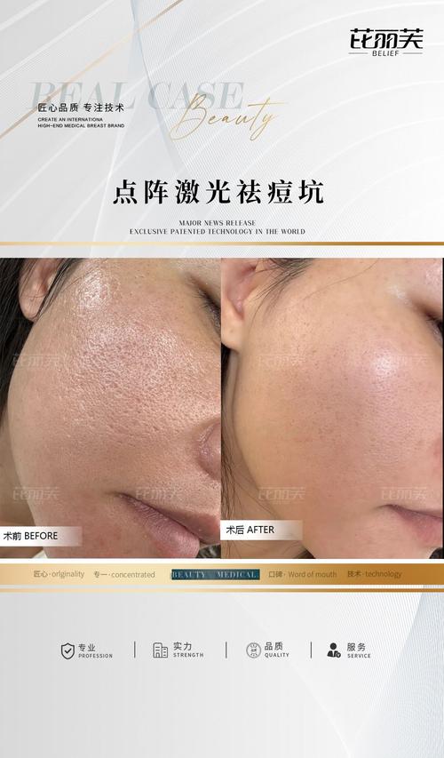 祛痘印激光还是光子更好?-图2 祛痘印激光还是光子更好?-图2