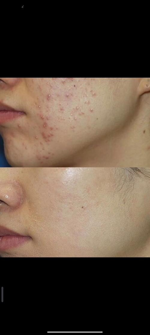 粉刺针消毒就能祛痘?靠谱吗?-图3 粉刺针消毒就能祛痘?靠谱吗?-图3