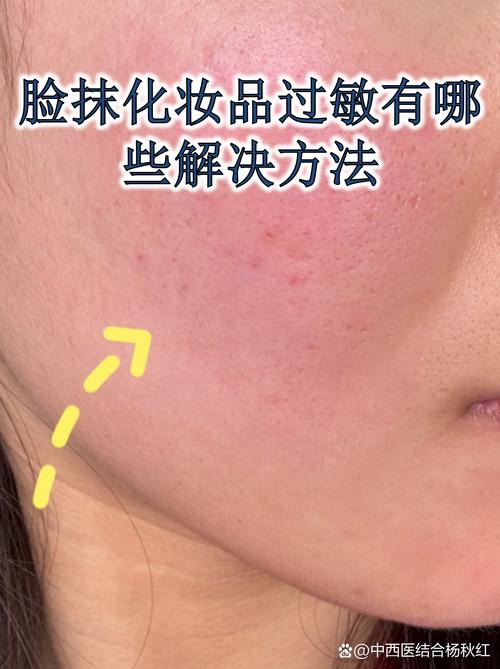 脸过敏了还能用护肤品吗?-图3 脸过敏了还能用护肤品吗?-图3