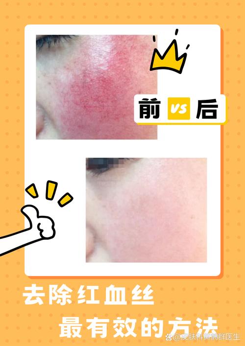 什么护肤品能有效去红血丝?-图2 什么护肤品能有效去红血丝?-图2