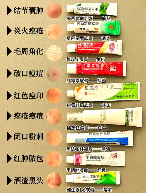 祛痘产品有用期哪里看-图1
