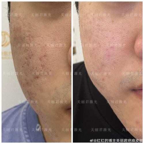 医院都能做激光祛痘吗?-图1 医院都能做激光祛痘吗?-图1