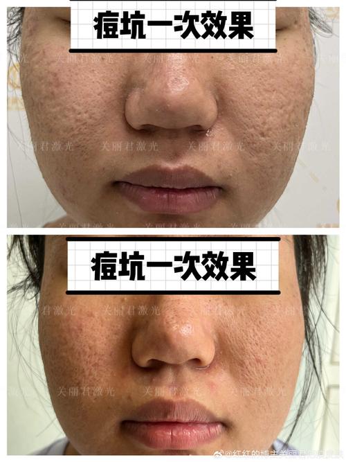 医院都能做激光祛痘吗?-图2 医院都能做激光祛痘吗?-图2