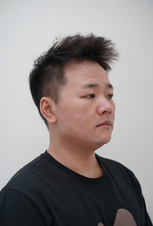 医院都能做激光祛痘吗?-图3 医院都能做激光祛痘吗?-图3