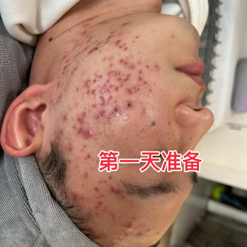 激光祛痘后出血怎么办？-图1