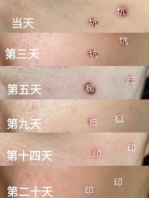 激光祛痘后出血怎么办？-图2